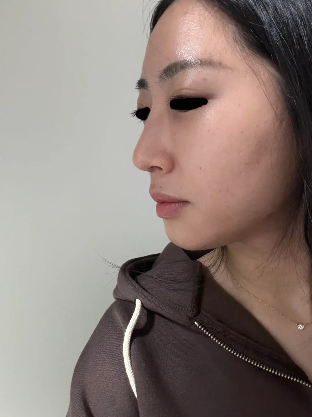 Apgujeong Seoul Plastic Surgery — 4