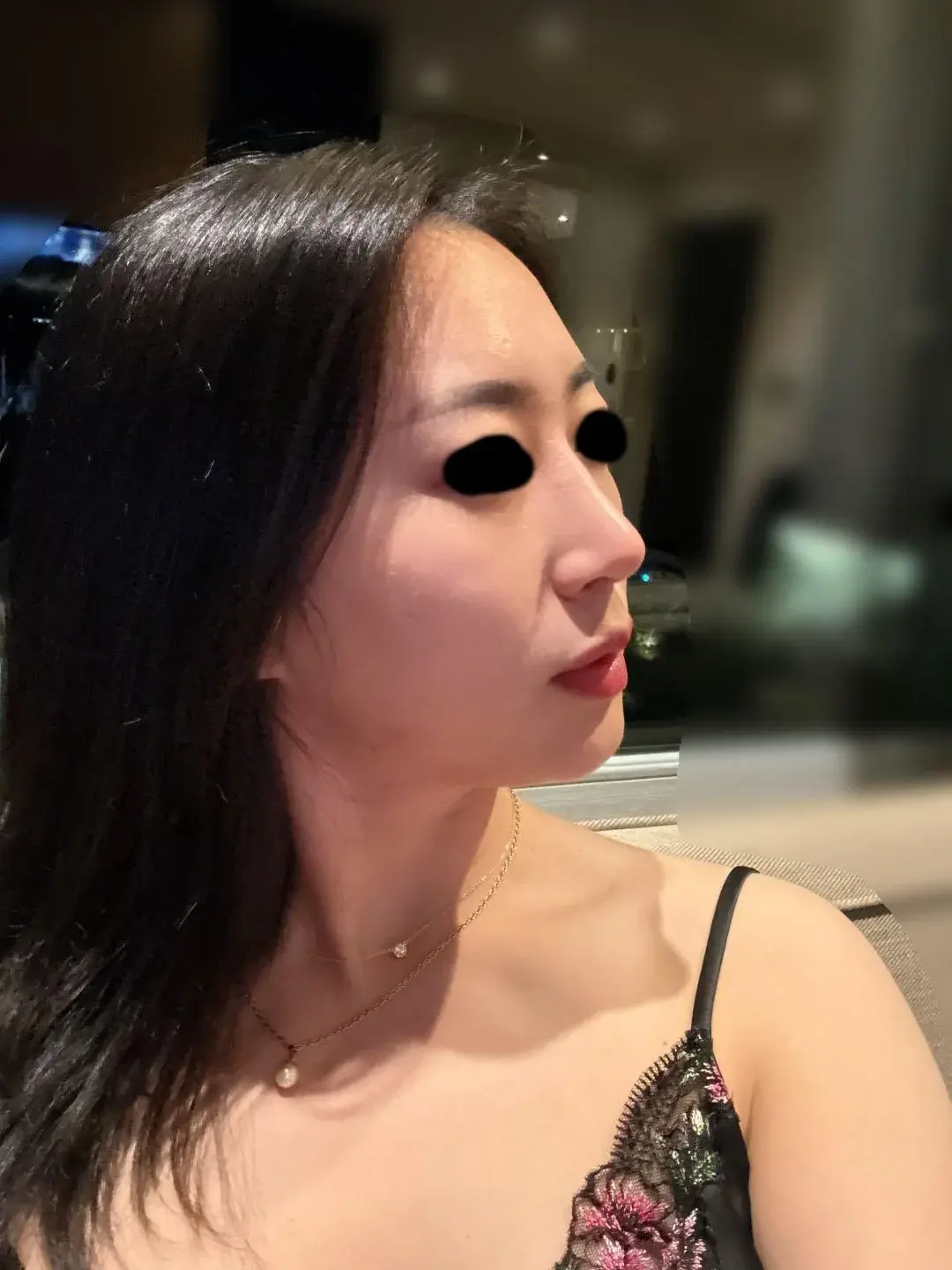 Apgujeong Seoul Plastic Surgery — 6