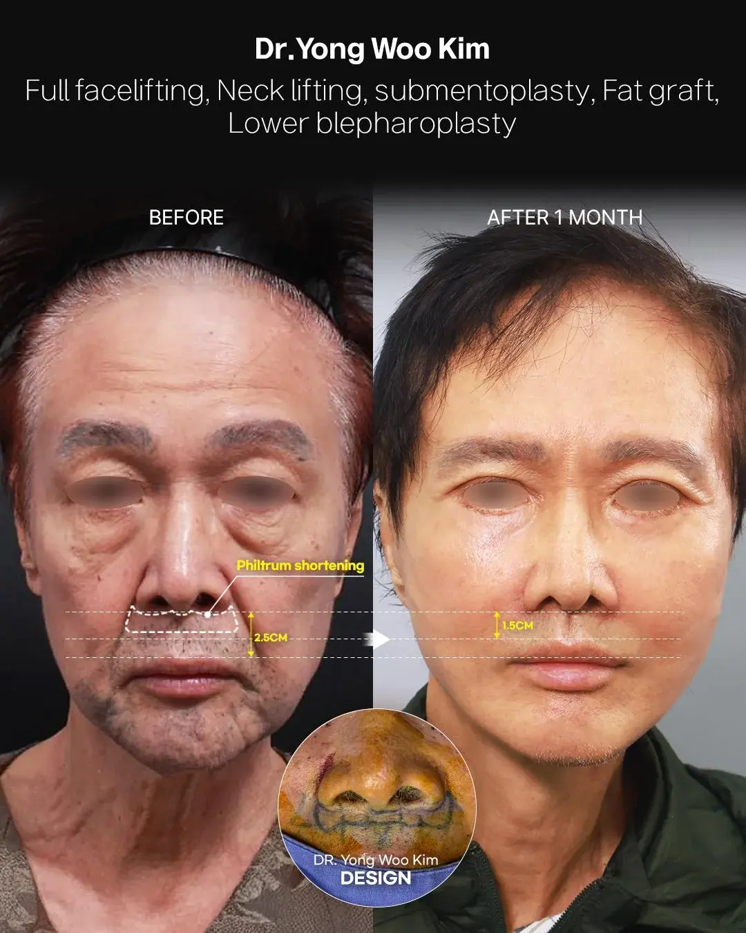 RETURNING Plastic Surgery — 2