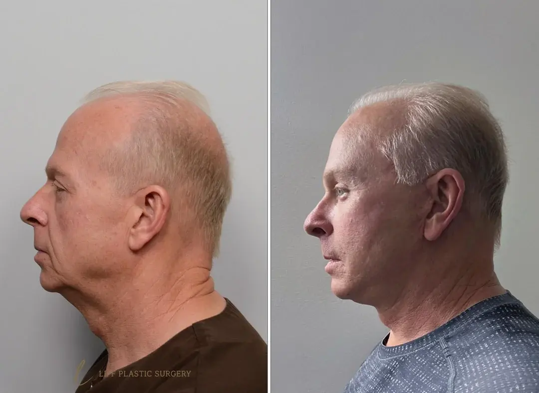 LIFF Plastic Surgery — 1