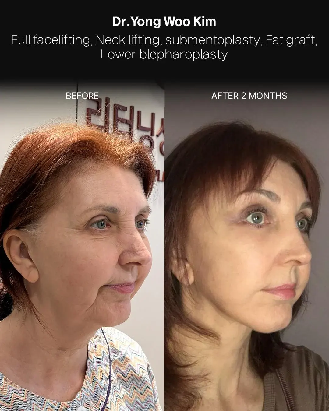 RETURNING Plastic Surgery — 2
