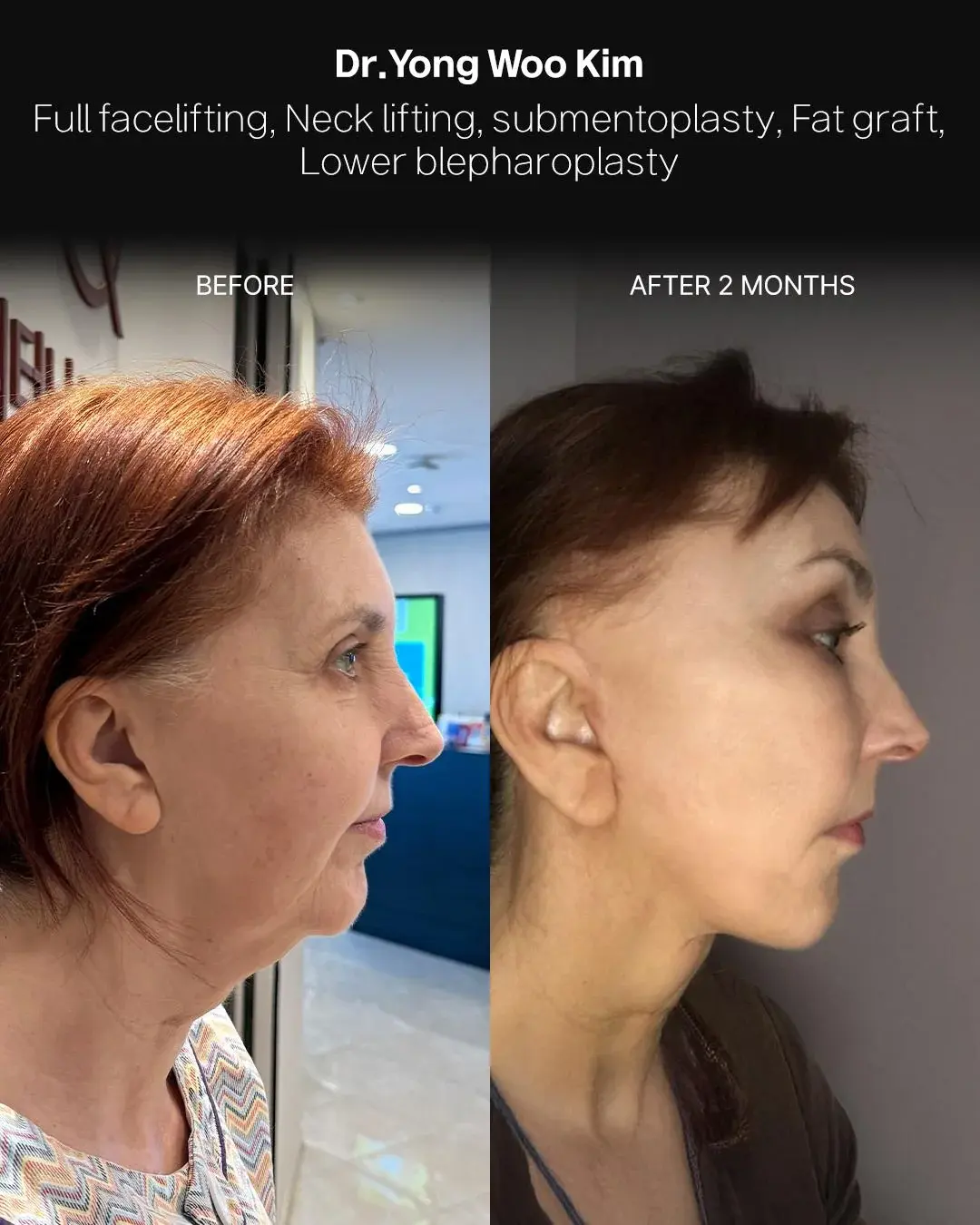 RETURNING Plastic Surgery — 3