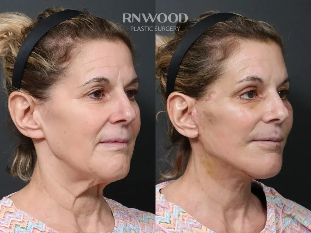 RNWOOD Plastic Surgery — 1