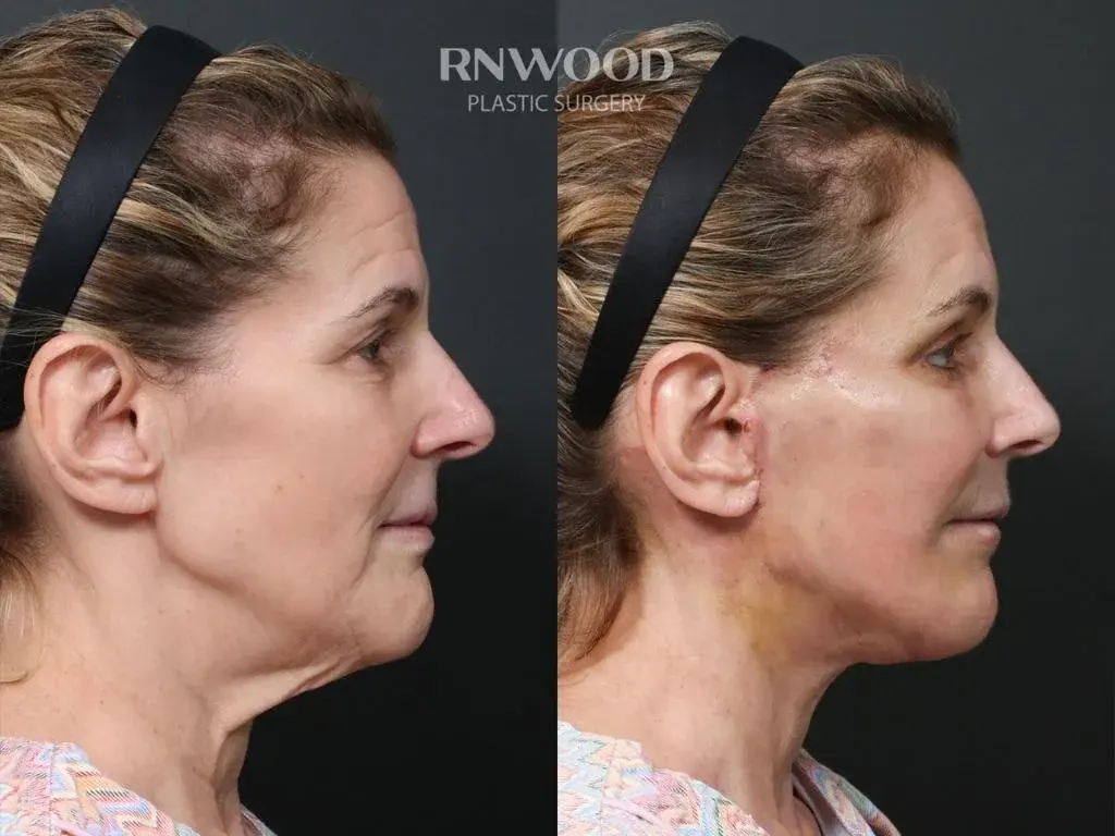 RNWOOD Plastic Surgery — 2