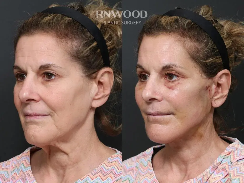 RNWOOD Plastic Surgery — 3