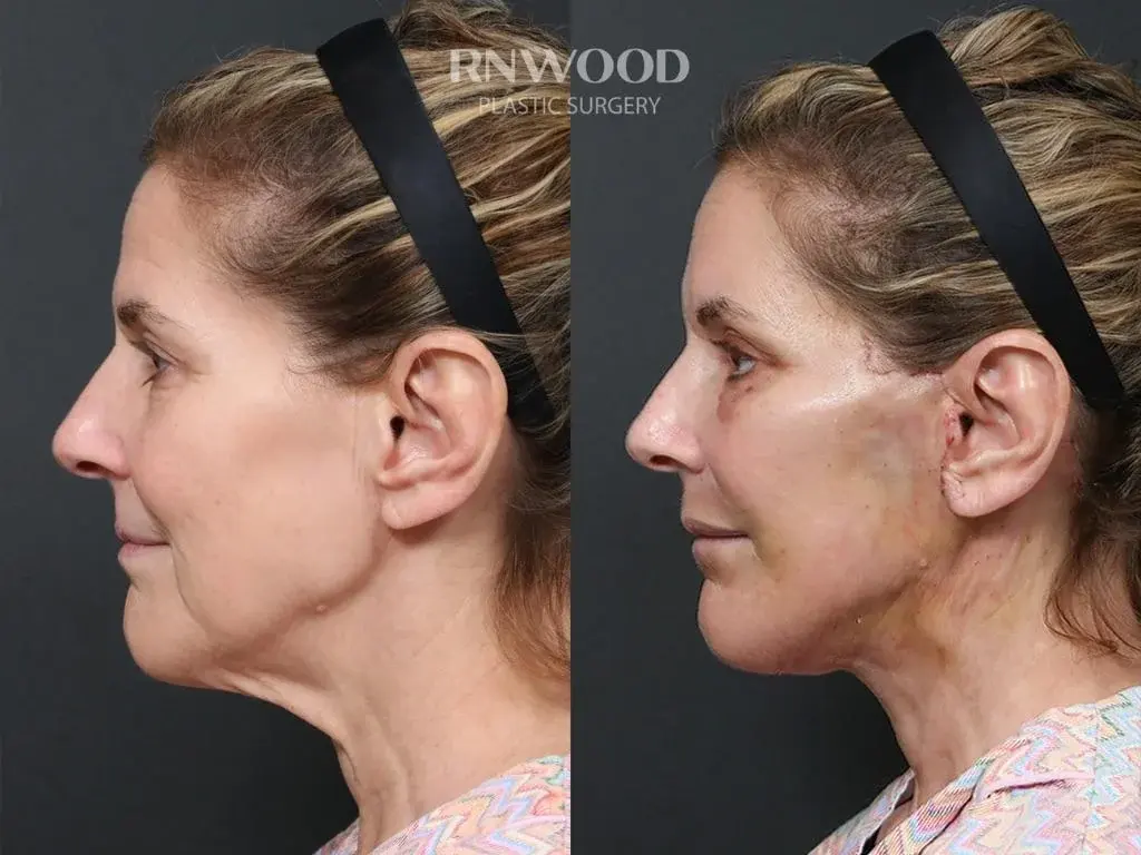 RNWOOD Plastic Surgery — 5