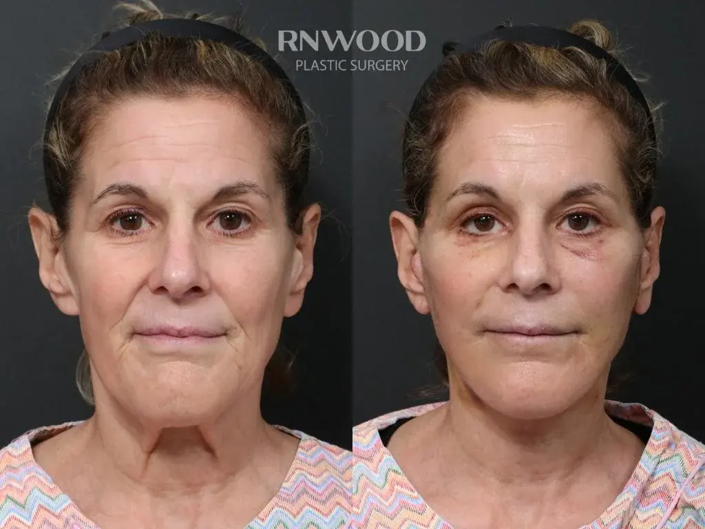 RNWOOD Plastic Surgery — 6