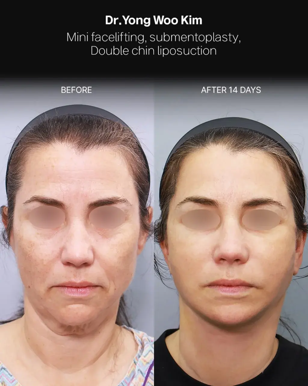 RETURNING Plastic Surgery — 1