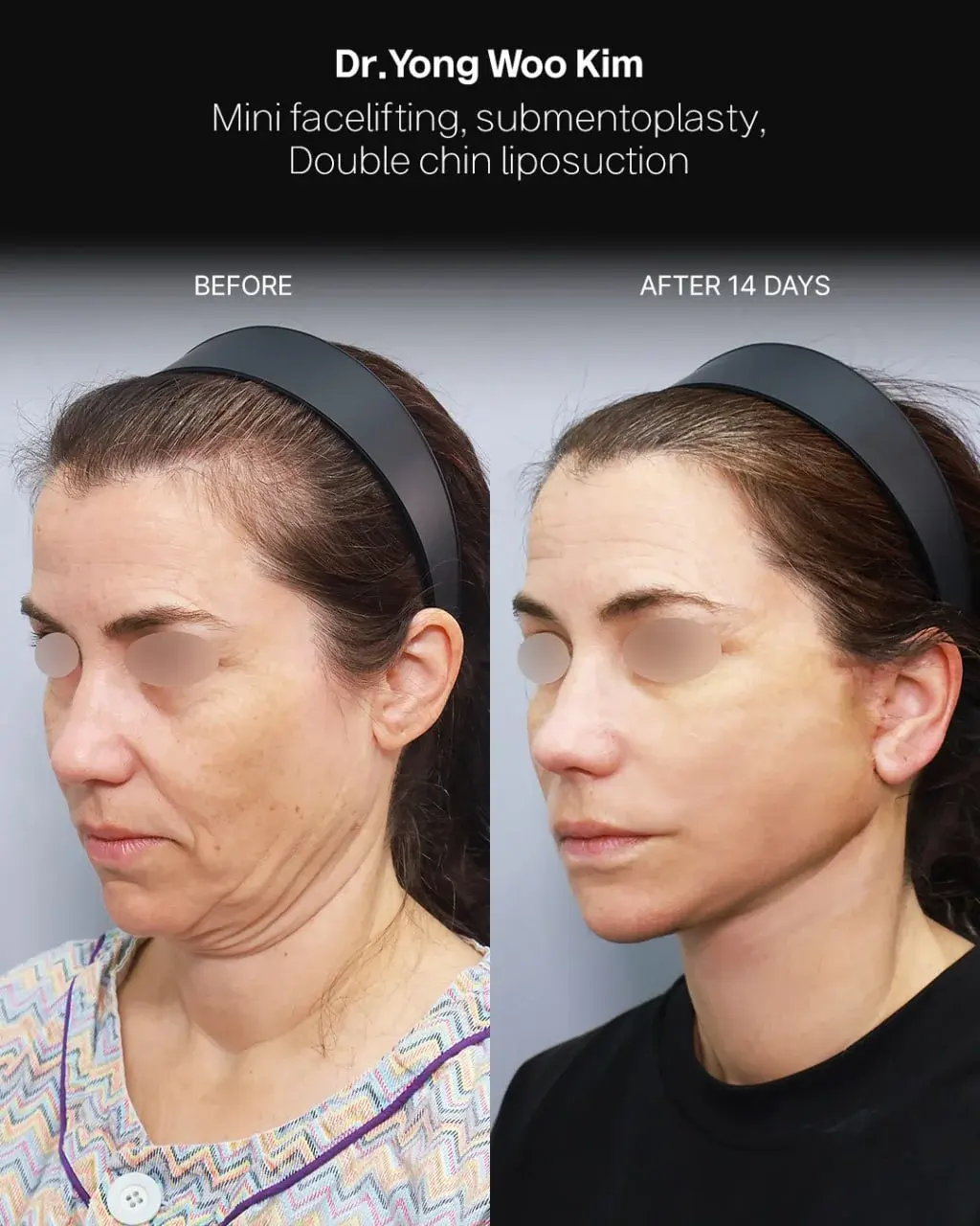 RETURNING Plastic Surgery — 2