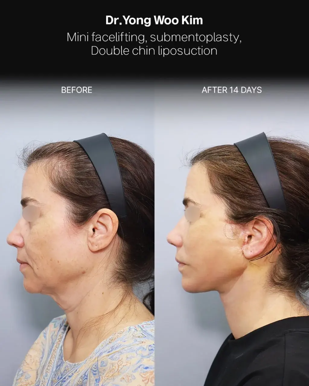 RETURNING Plastic Surgery — 3
