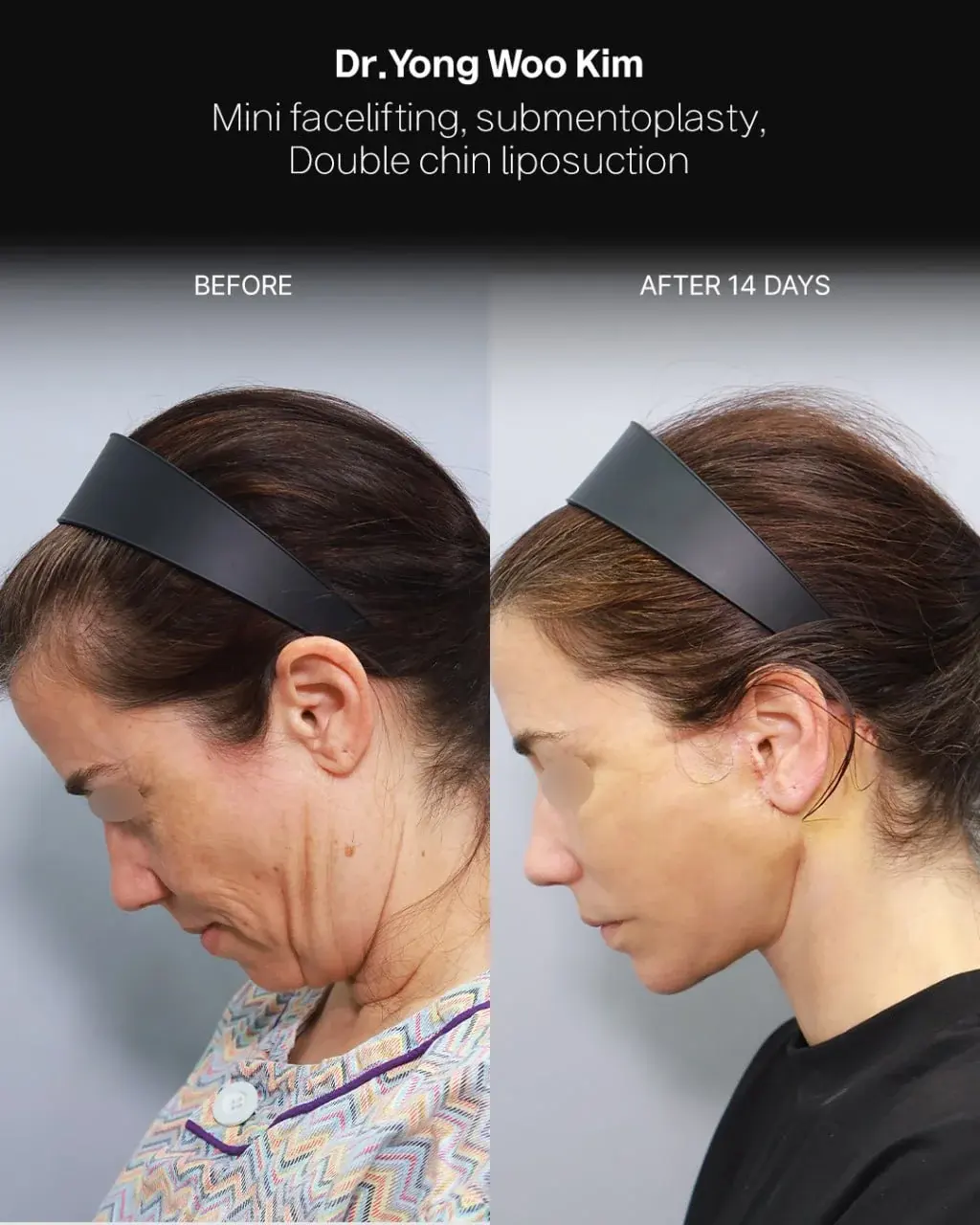 RETURNING Plastic Surgery — 4