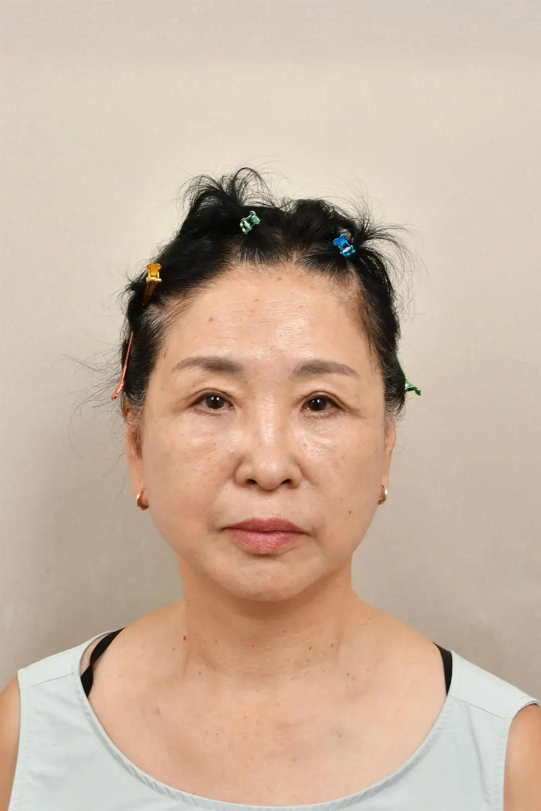 Apgujeong Seoul Plastic Surgery — 2