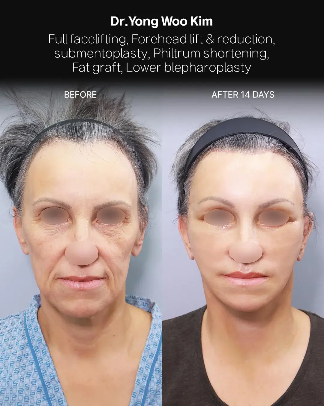 RETURNING Plastic Surgery — 1