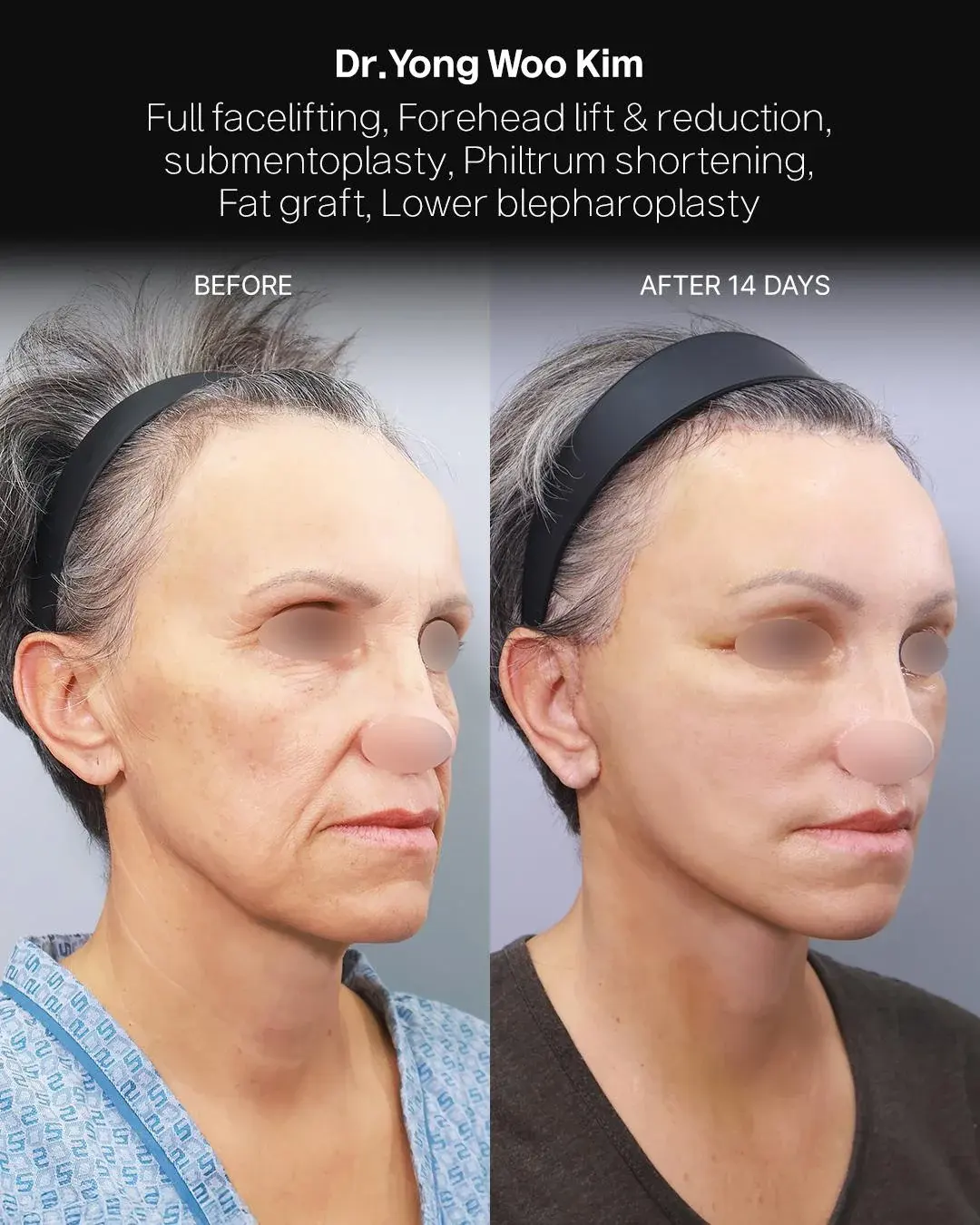 RETURNING Plastic Surgery — 2