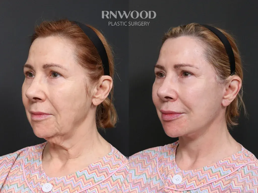 RNWOOD Plastic Surgery — 1