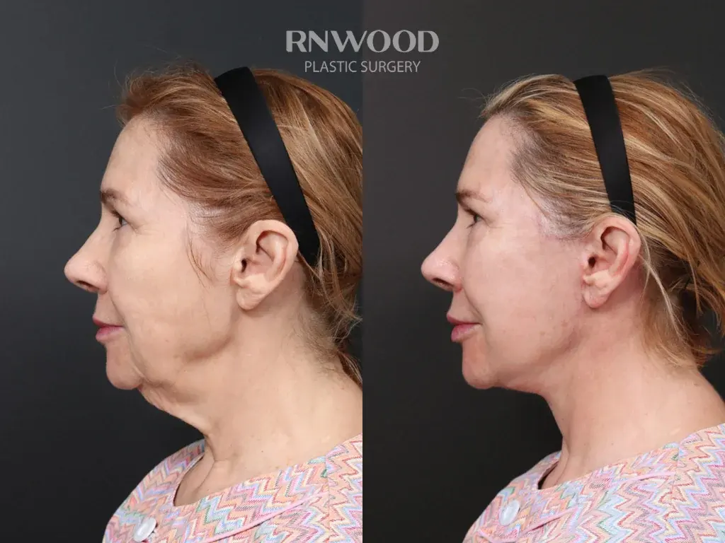 RNWOOD Plastic Surgery — 2
