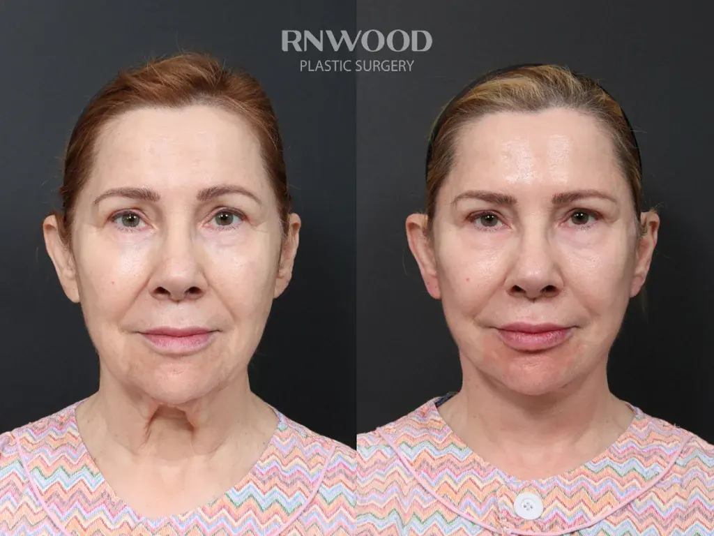 RNWOOD Plastic Surgery — 3