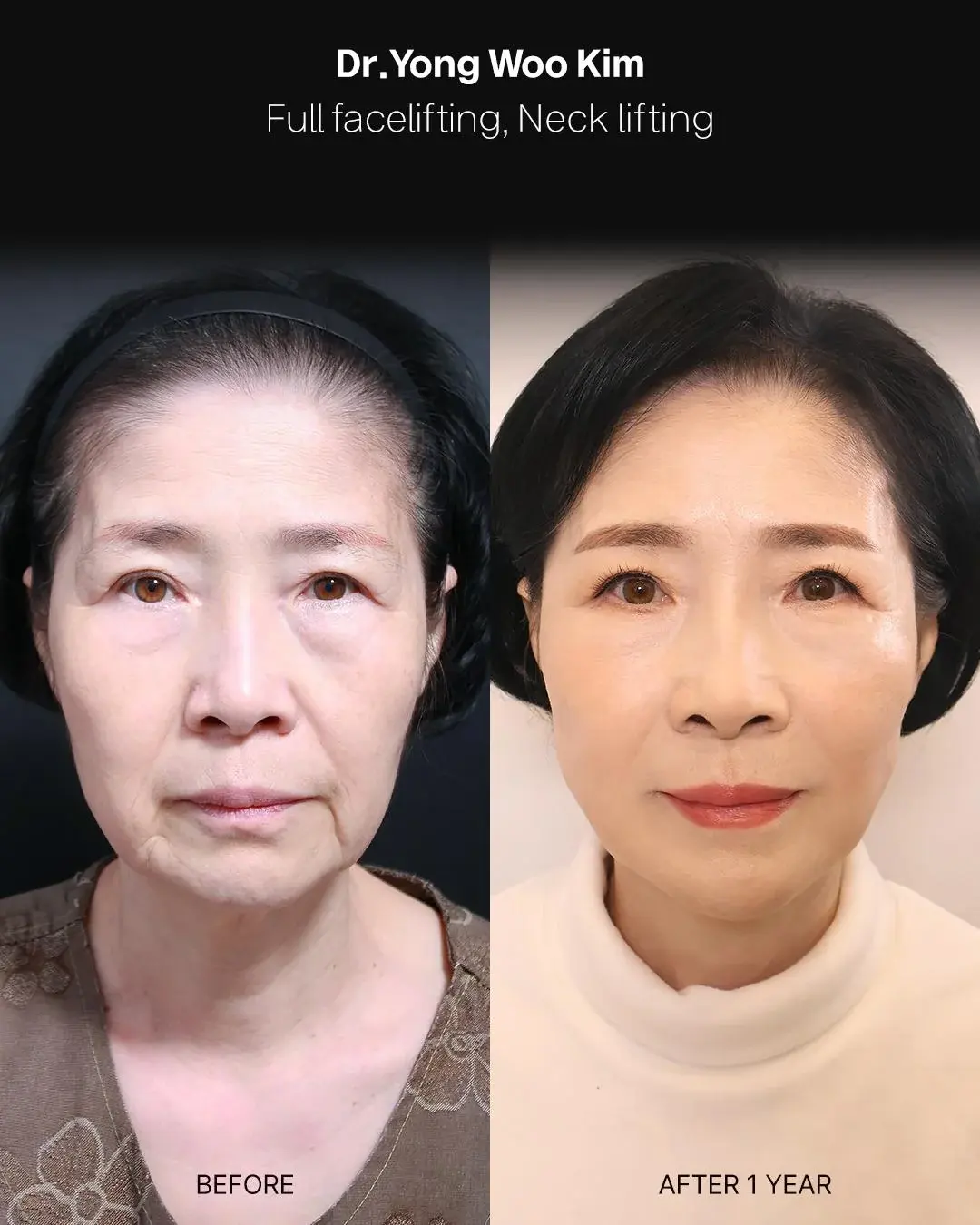 RETURNING Plastic Surgery — 1