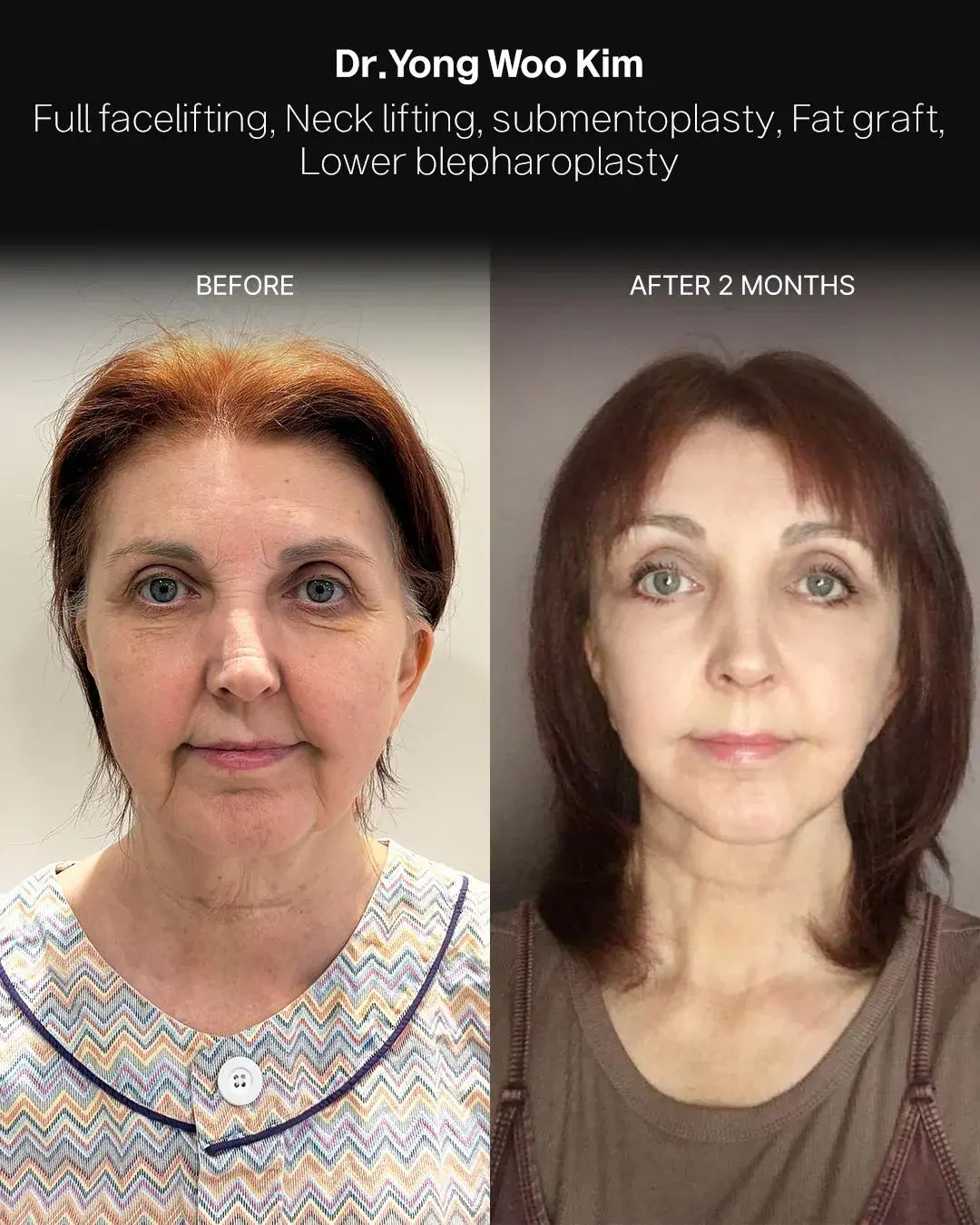 RETURNING Plastic Surgery — 1