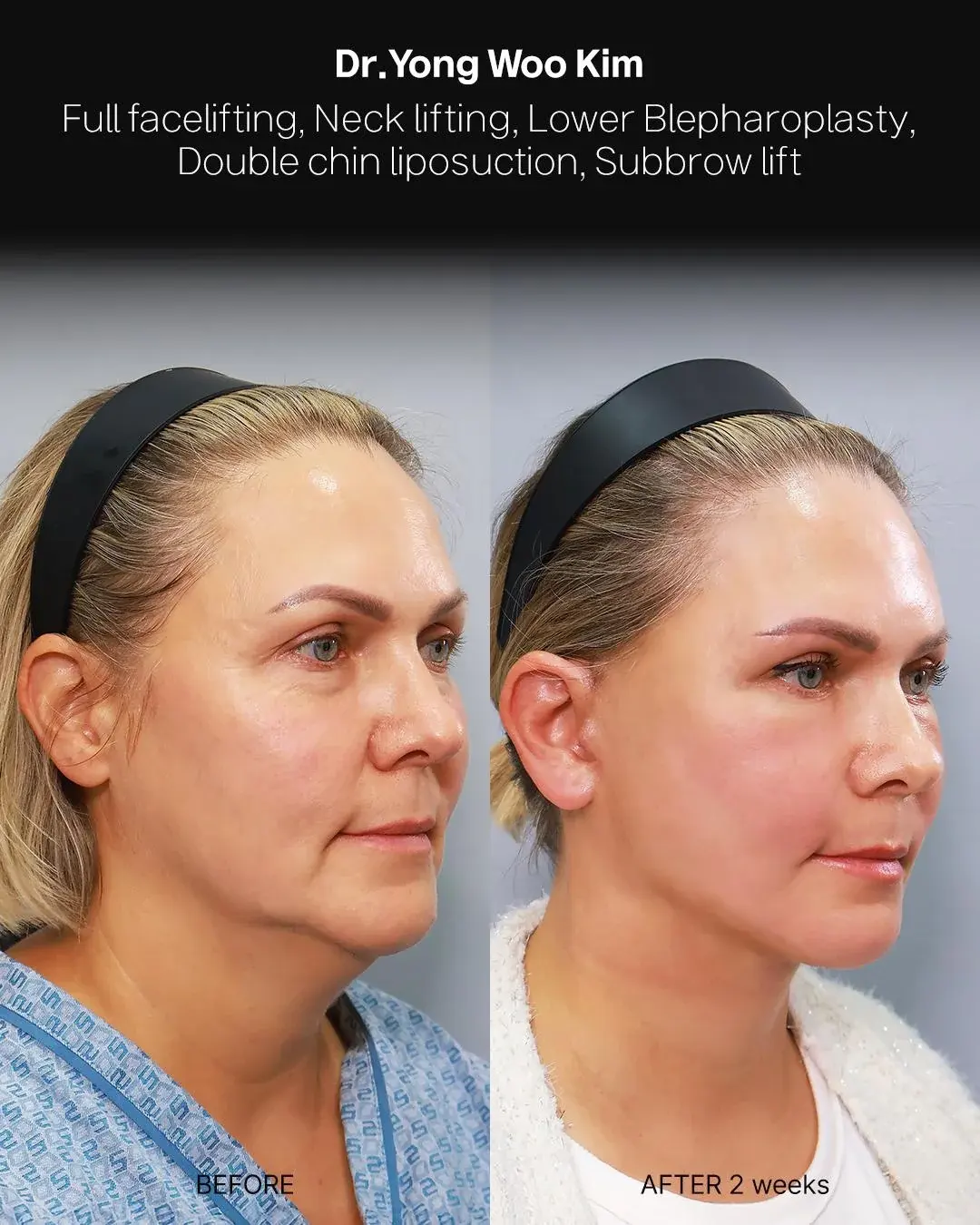 RETURNING Plastic Surgery — 2
