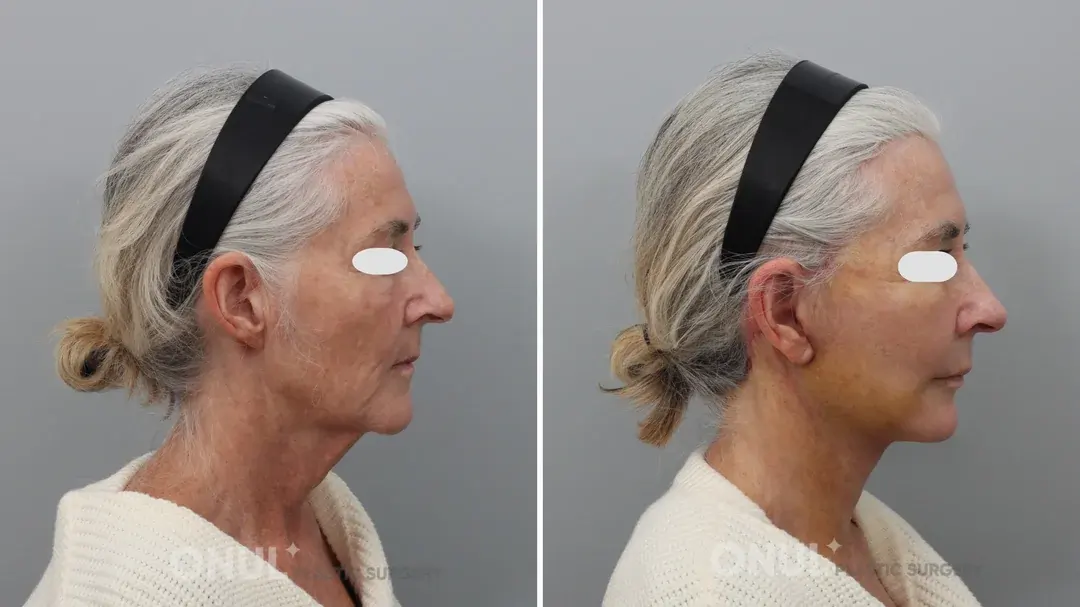 ONUL Plastic Surgery — 2