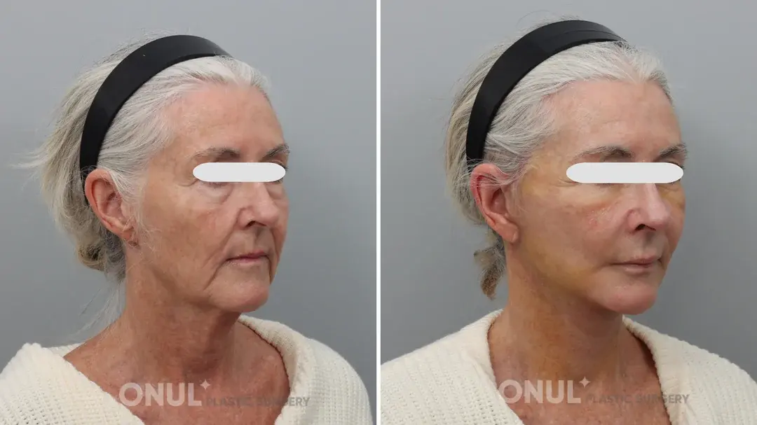 ONUL Plastic Surgery — 3
