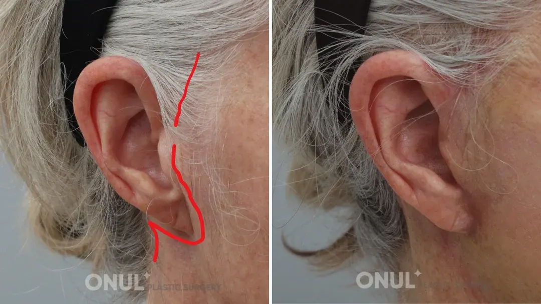 ONUL Plastic Surgery — 4