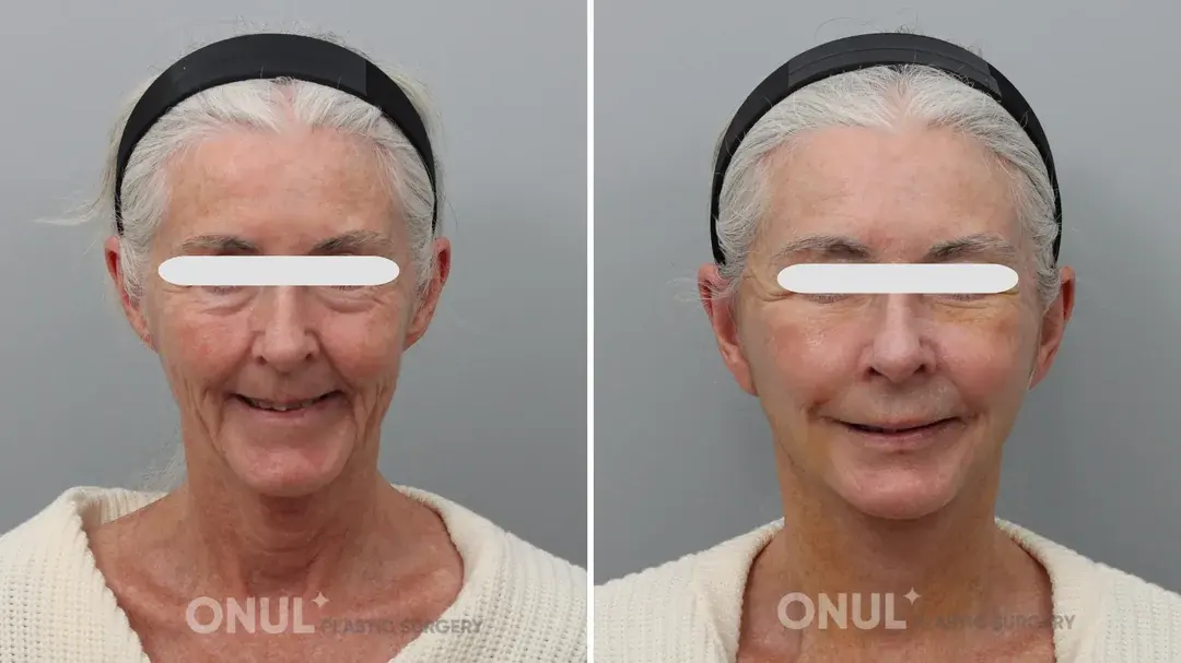 ONUL Plastic Surgery — 5