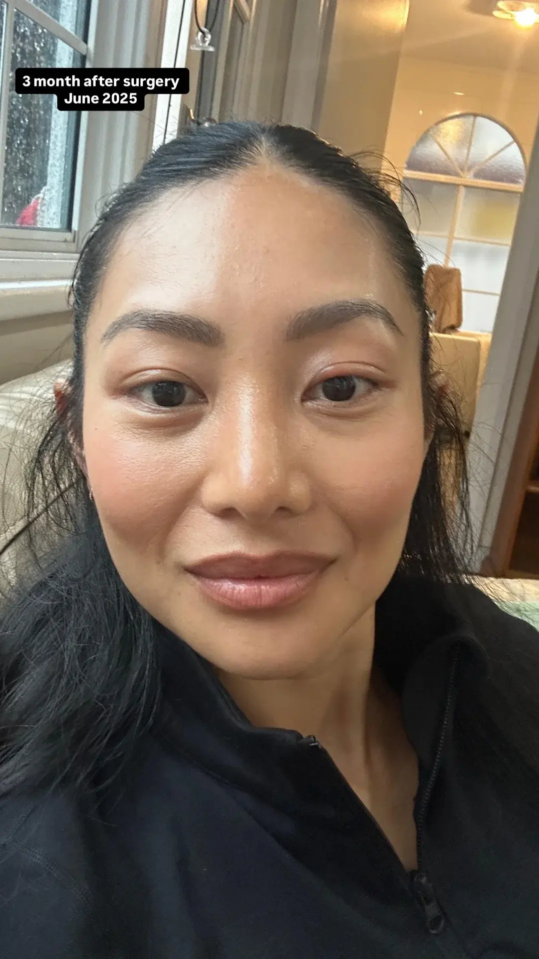 NANA Plastic Surgery — 14